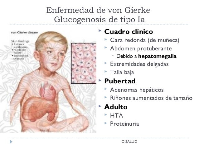 ENFERMEDAD DE VON GIERKE PDF